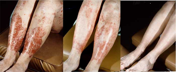 PsoriasisExamples PsoriasisExamples